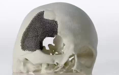 顱骨3D打印技術(shù)是什么？